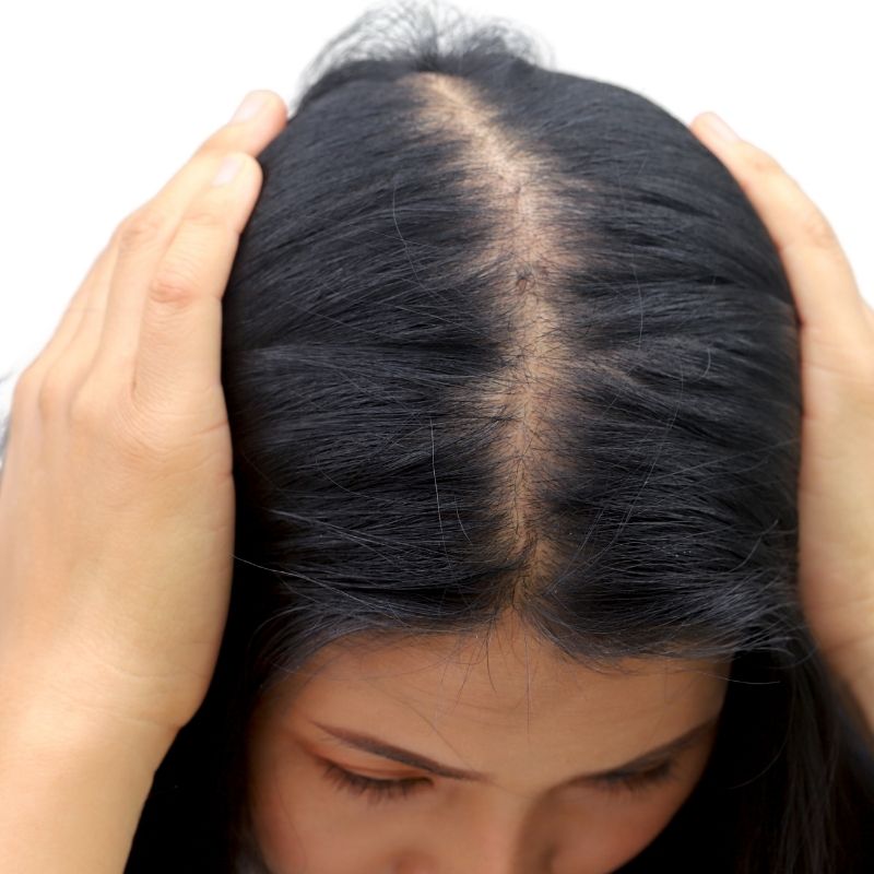 Kadınlarda Saç Ekimi