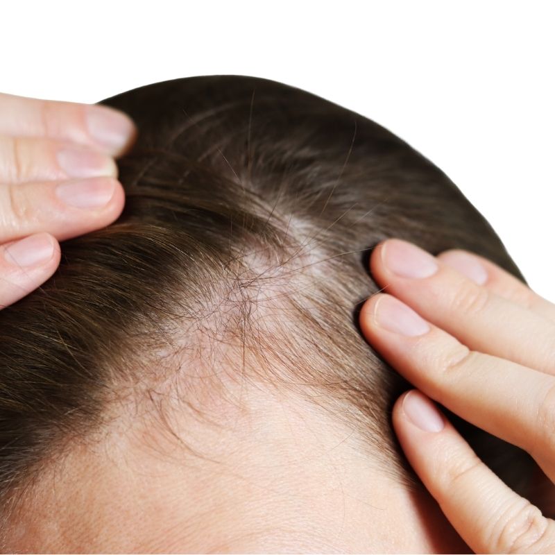 Kadınlarda Saç Ekimi