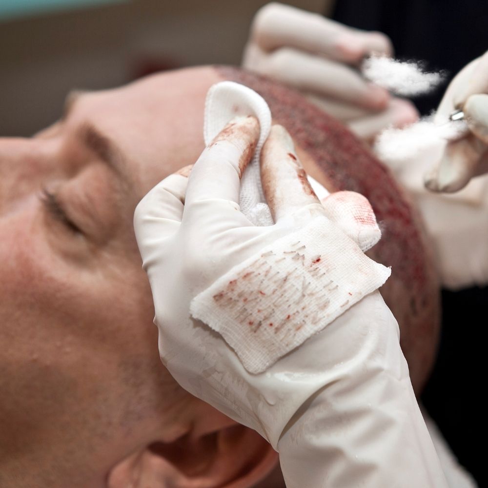 Saç ekimi sonrası bere ne zaman takılır