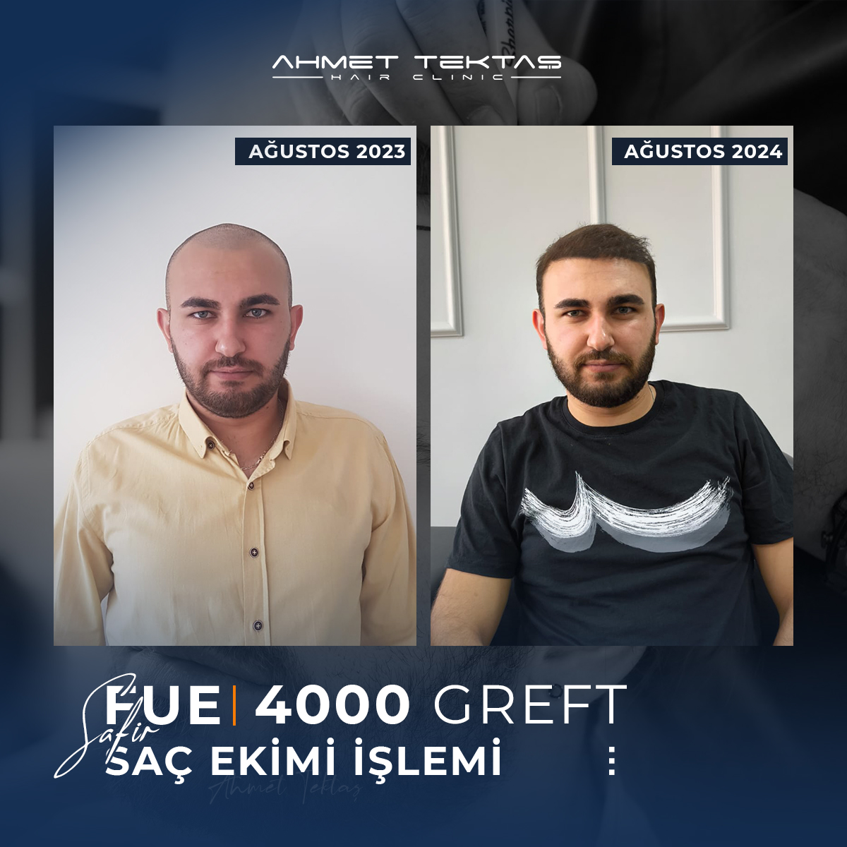 2500 Greft Saç Ekimi Fiyatları