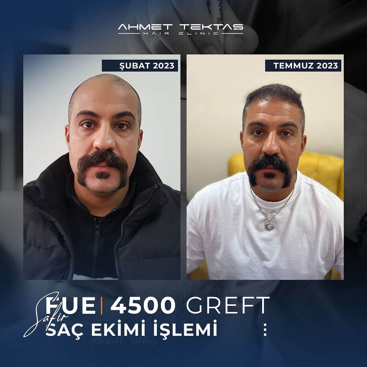 3500 Greft Saç Ekimi Fiyatları