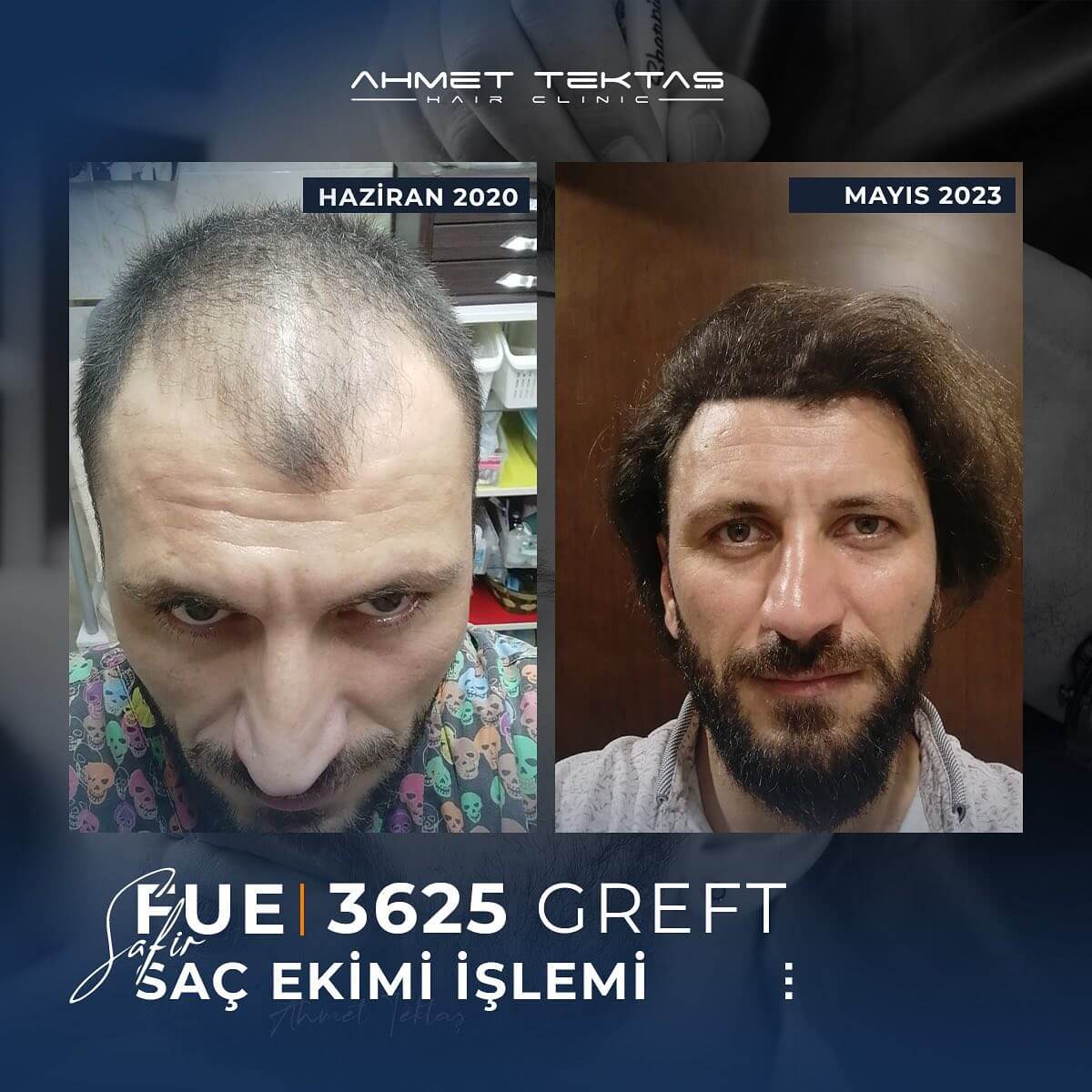 4000 Greft Saç Ekimi Fiyatları