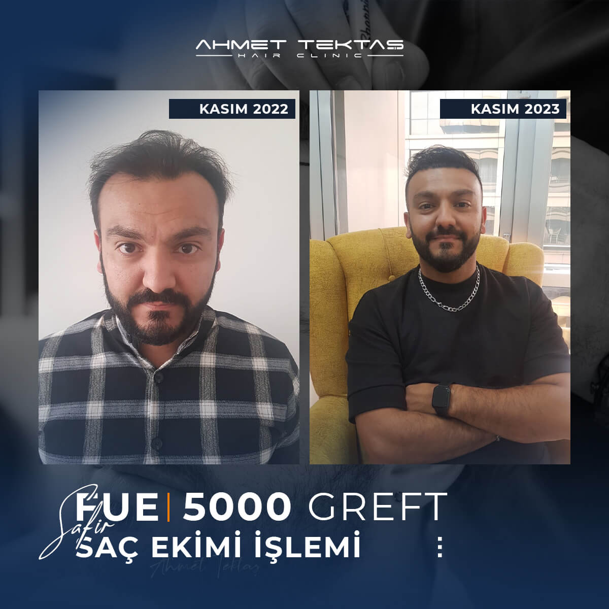 4000 Greft Saç Ekimi Fiyatları