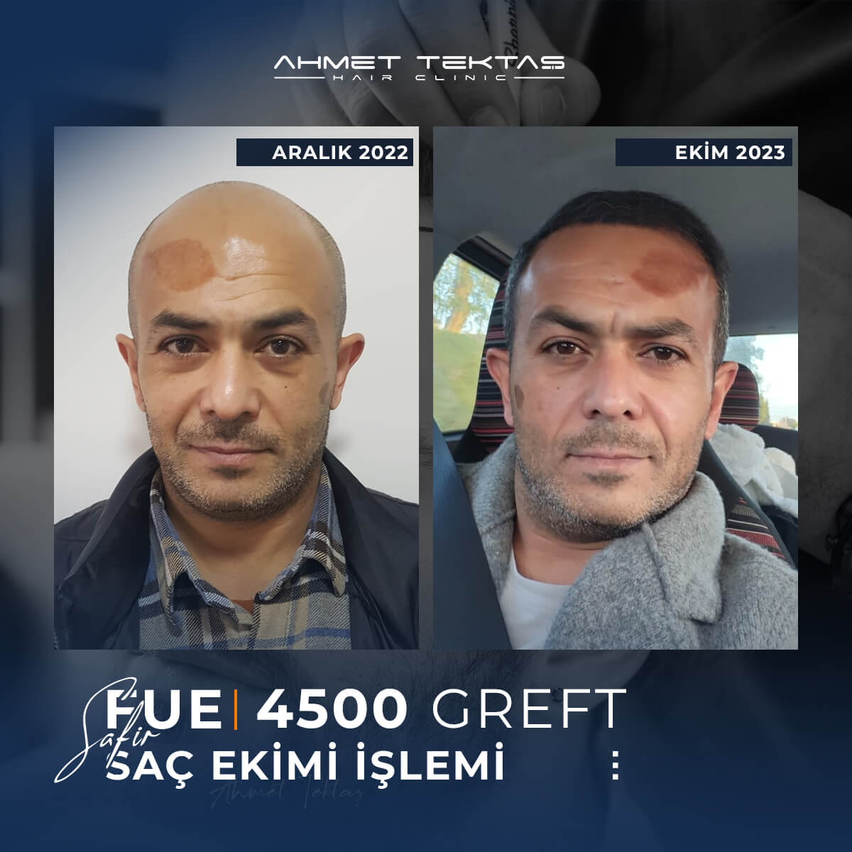 4500 Greft Saç Ekimi Fiyatları