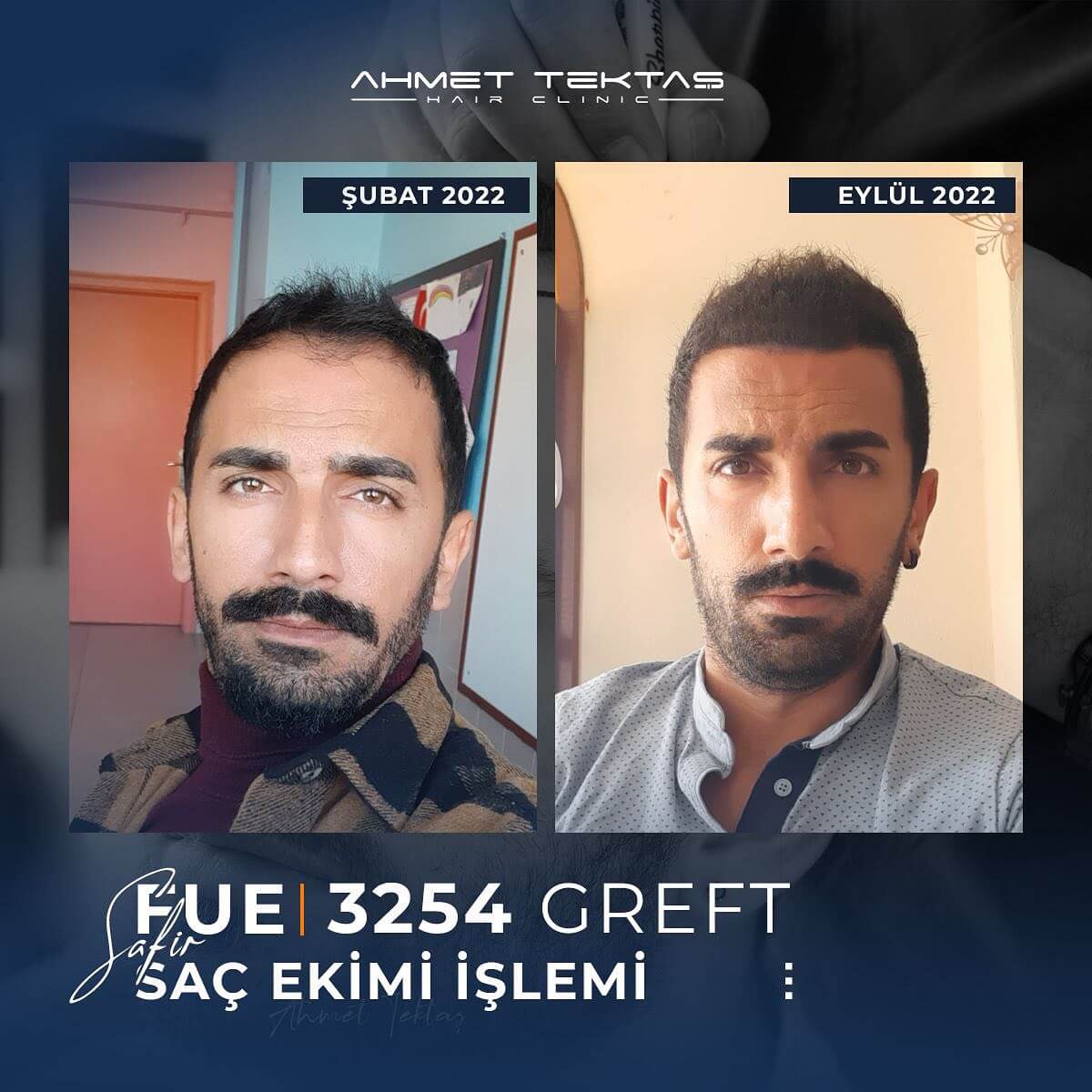 4500 Greft Saç Ekimi Fiyatları