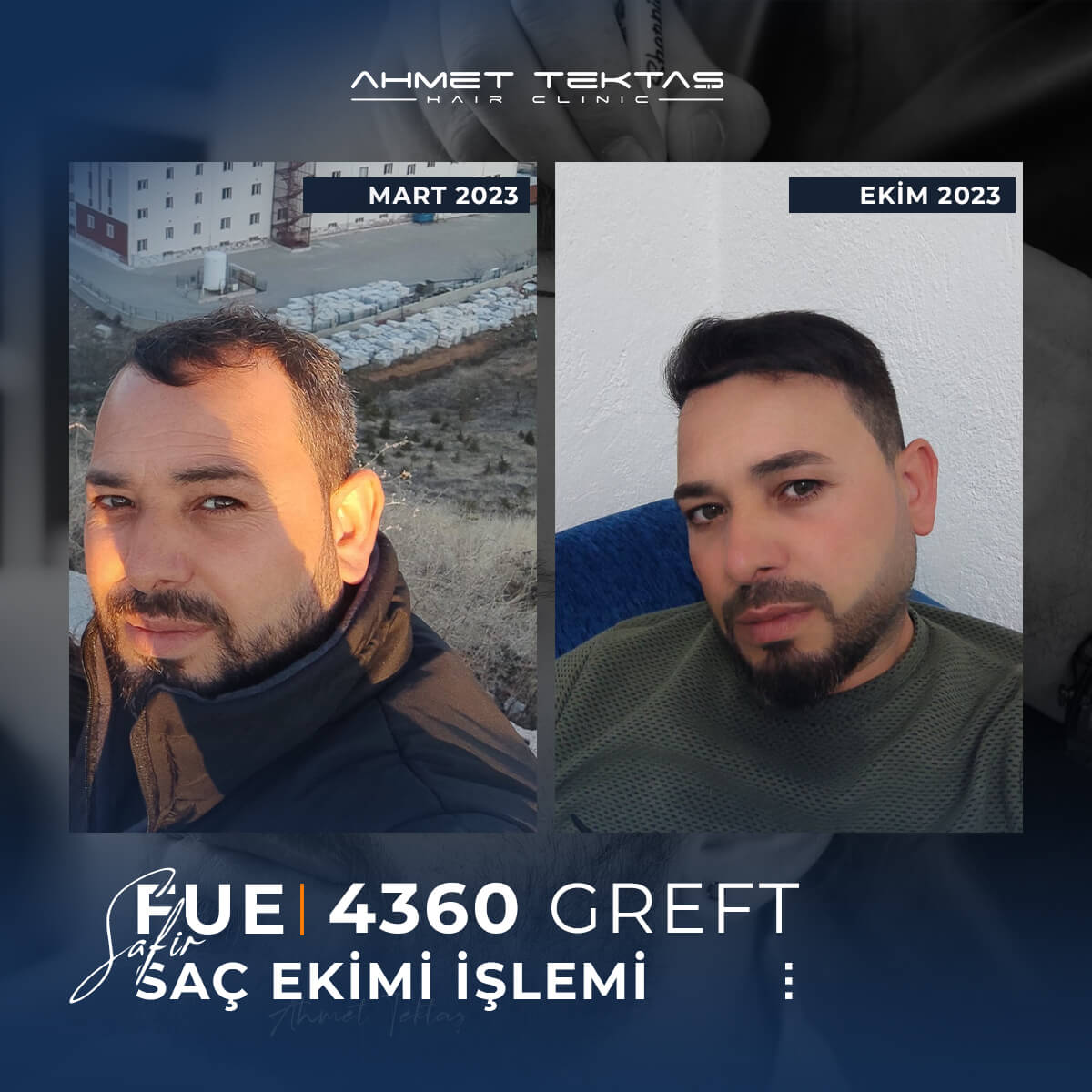 4500 Greft Saç Ekimi Fiyatları