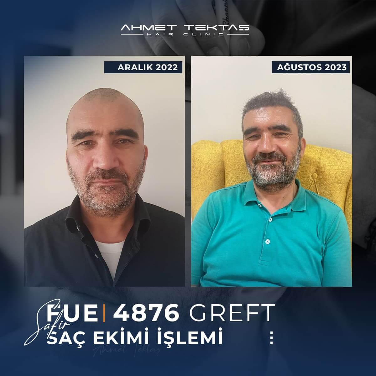 4500 Greft Saç Ekimi Fiyatları