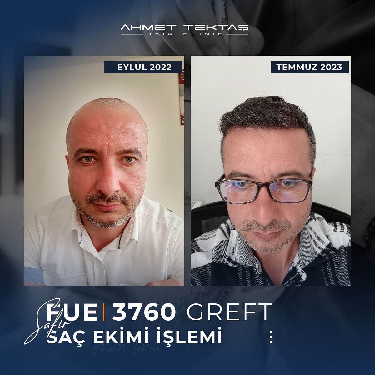 5000 Greft Saç Ekimi Fiyatları