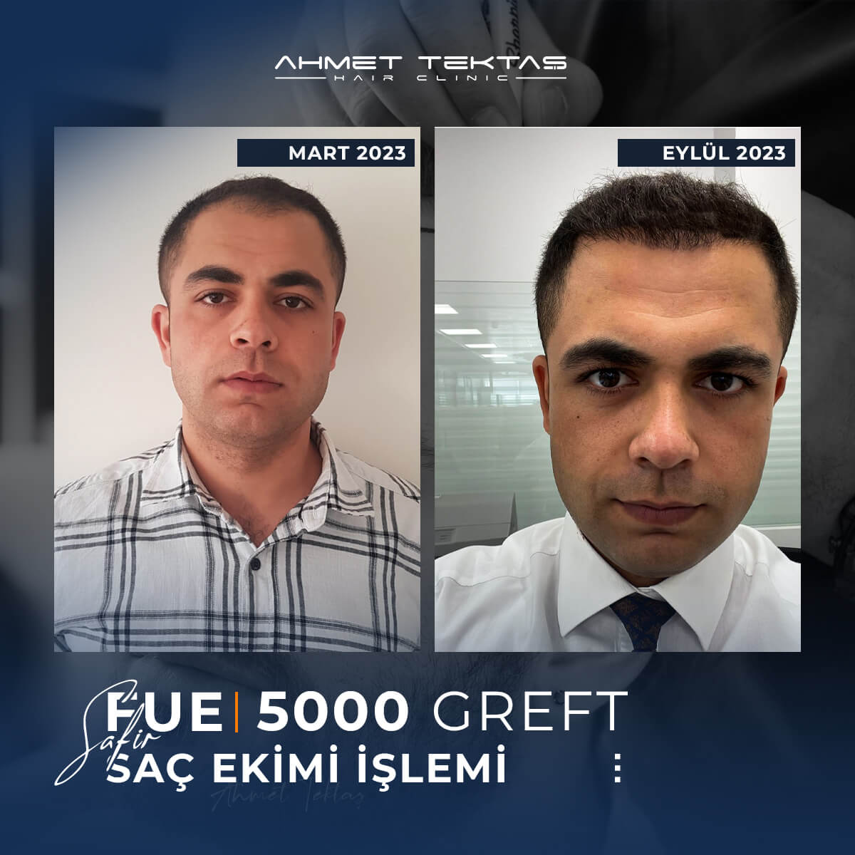5000 Greft Saç Ekimi Fiyatları