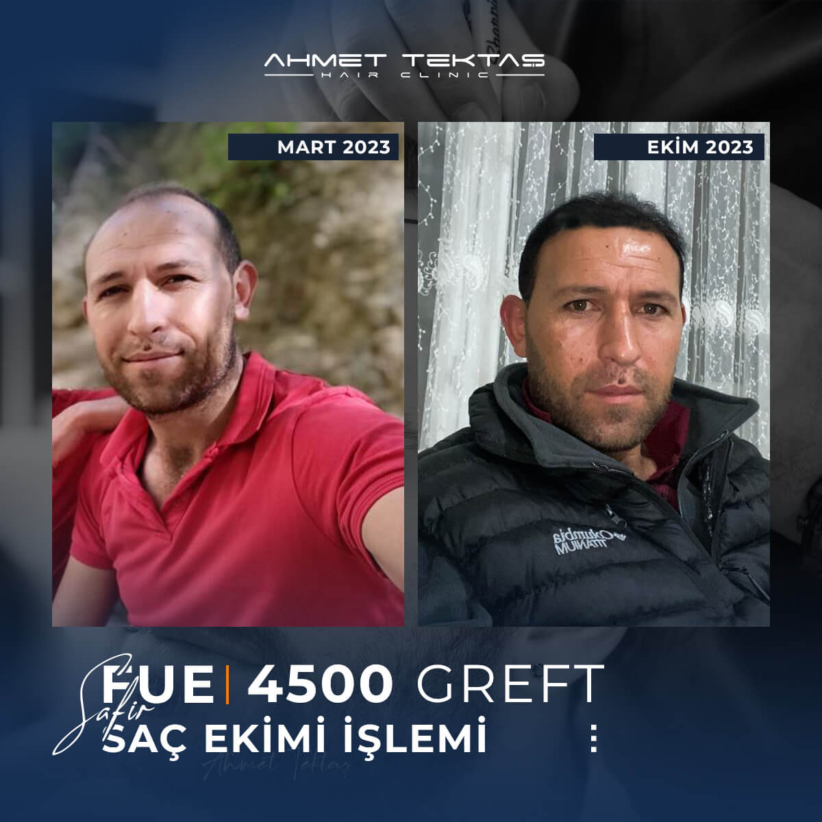 5500 Greft Saç Ekimi Fiyatları