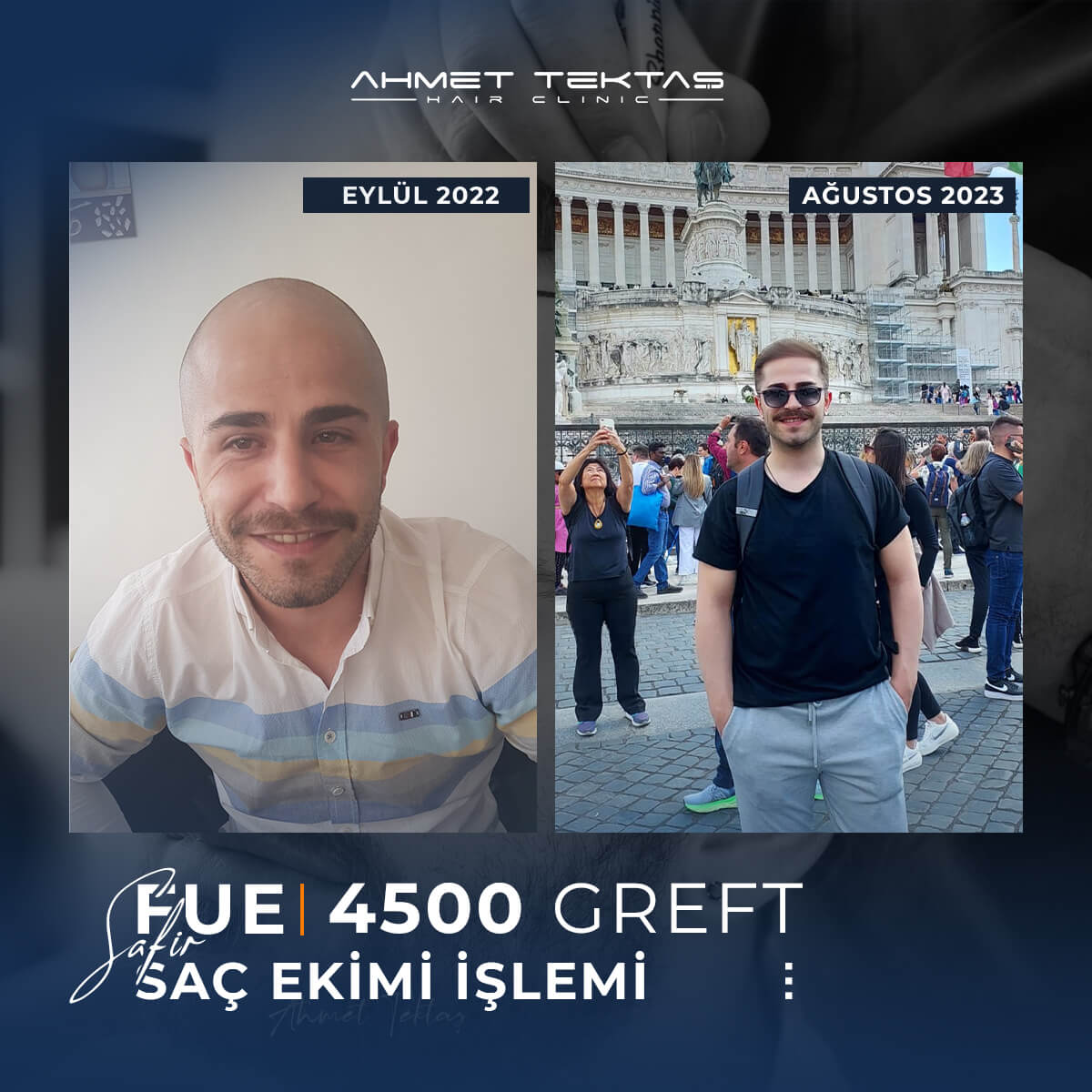 5500 Greft Saç Ekimi Fiyatları