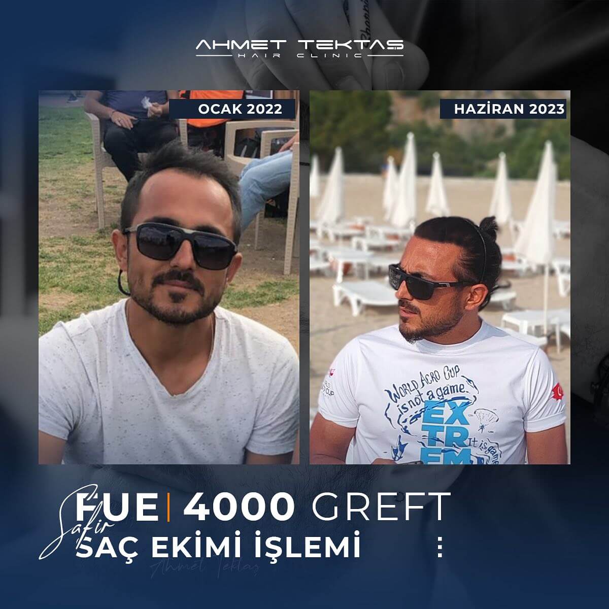 6000 Greft Saç Ekimi Fiyatları