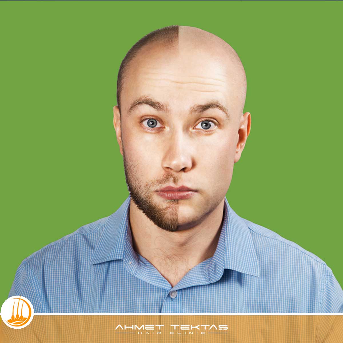 Aksaray VIP Saç Ekimi