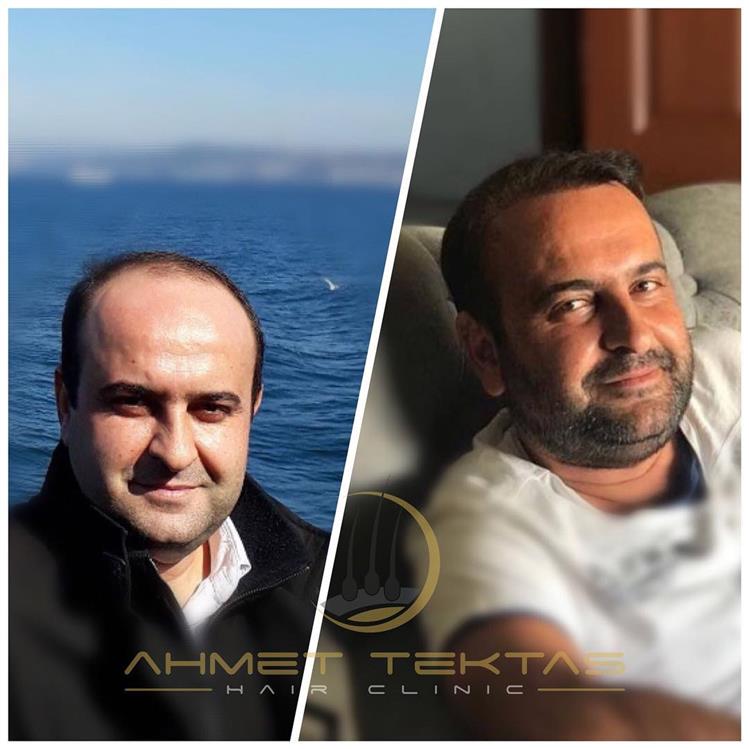 Antalya Saç Ekimi Antalya Saç Ekimi