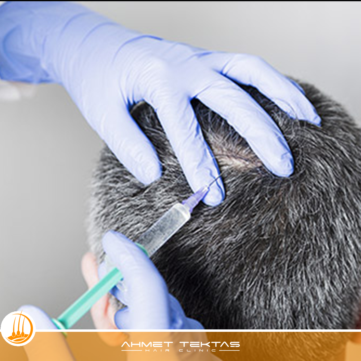 Kahramanmaraş Saç Mezoterapisi