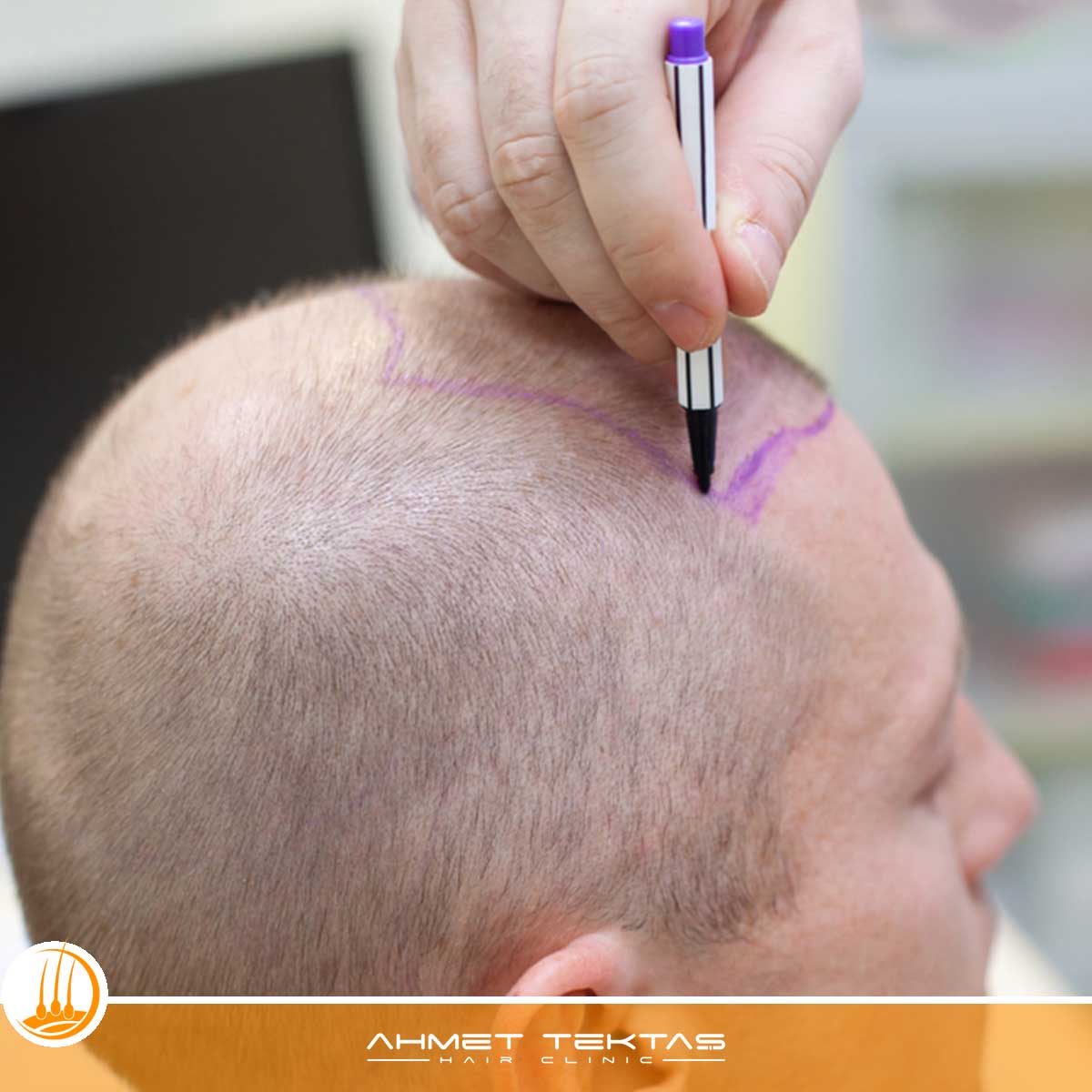 Kahramanmaraş VIP Saç Ekimi