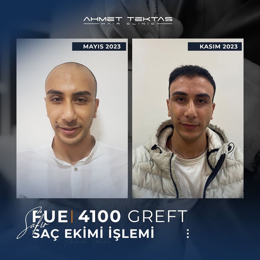Kayseri Saç Ekimi, Akif Bey Kayseri Saç Ekimi, Akif Bey