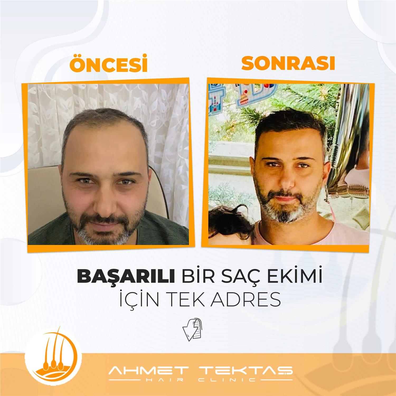 Kayseri Saç Ekimi, Burak Bey Kayseri Saç Ekimi, Burak Bey