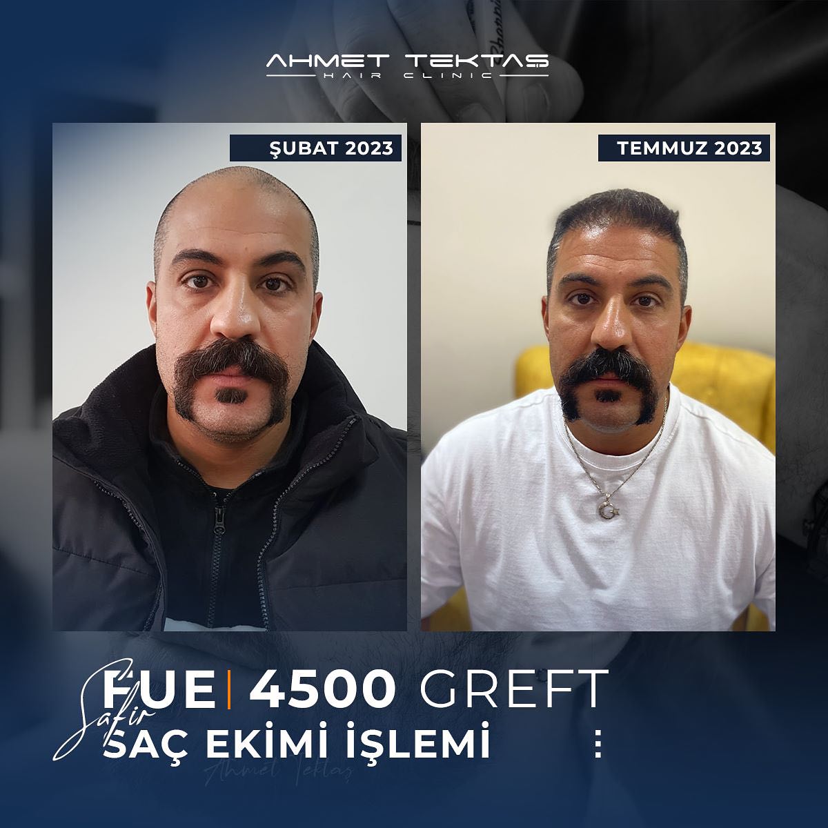 Kayseri Saç Ekimi, Celal Bey Kayseri Saç Ekimi, Celal Bey
