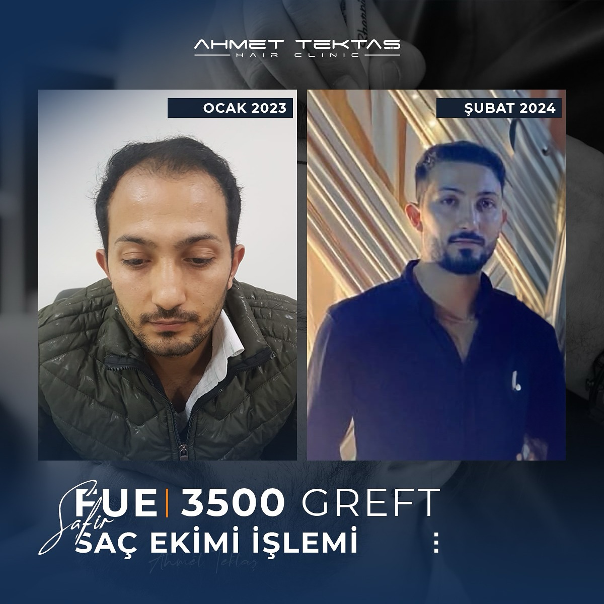 Kayseri Saç Ekimi, Enes Bey Kayseri Saç Ekimi, Enes Bey