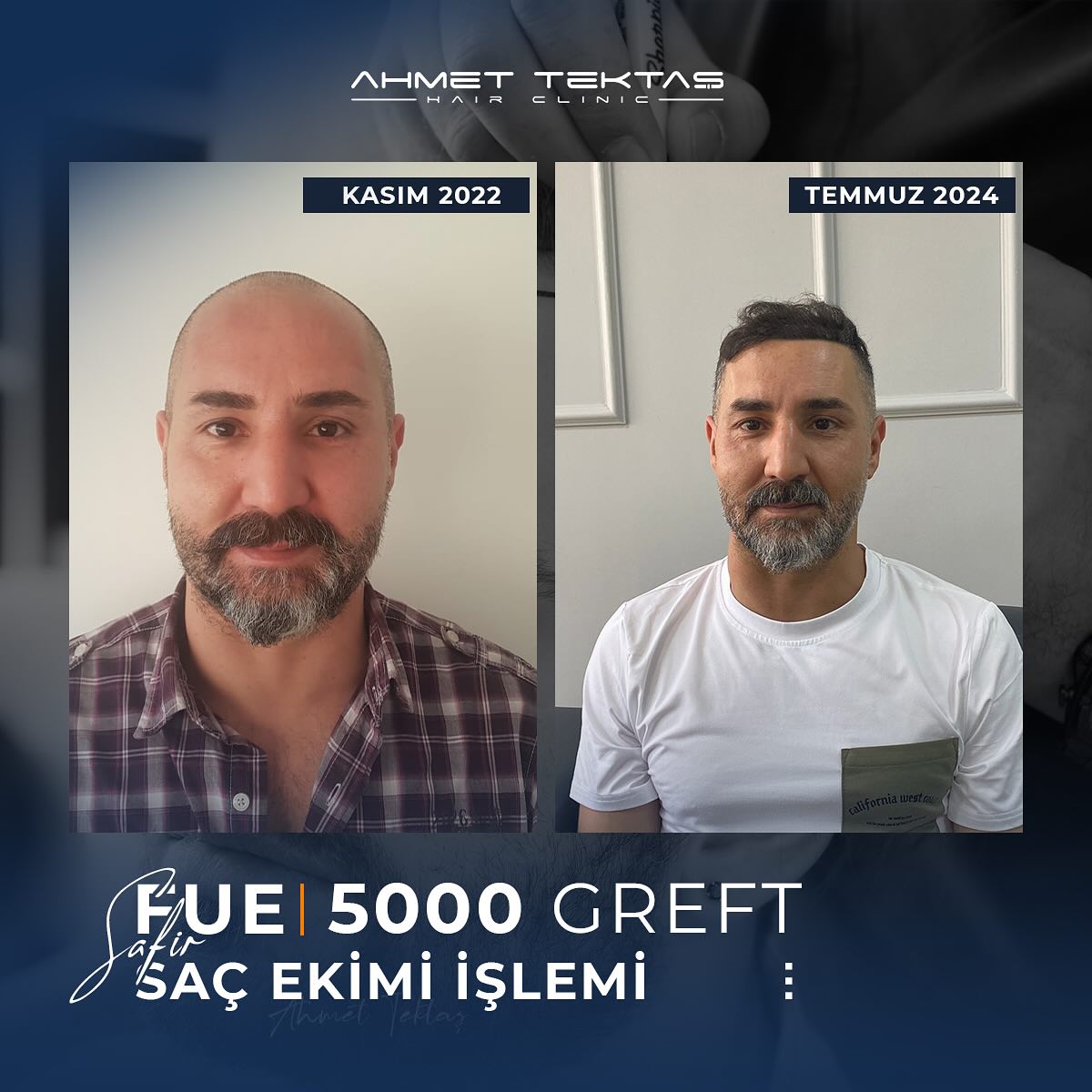 Kayseri Saç Ekimi, Erdem Bey Kayseri Saç Ekimi, Erdem Bey