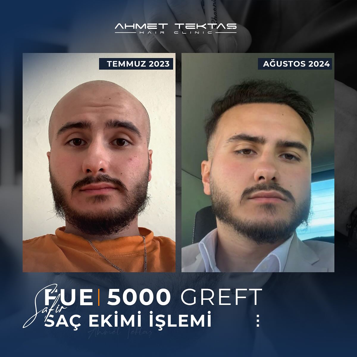 Kayseri Saç Ekimi, Eren Bey Kayseri Saç Ekimi, Eren Bey