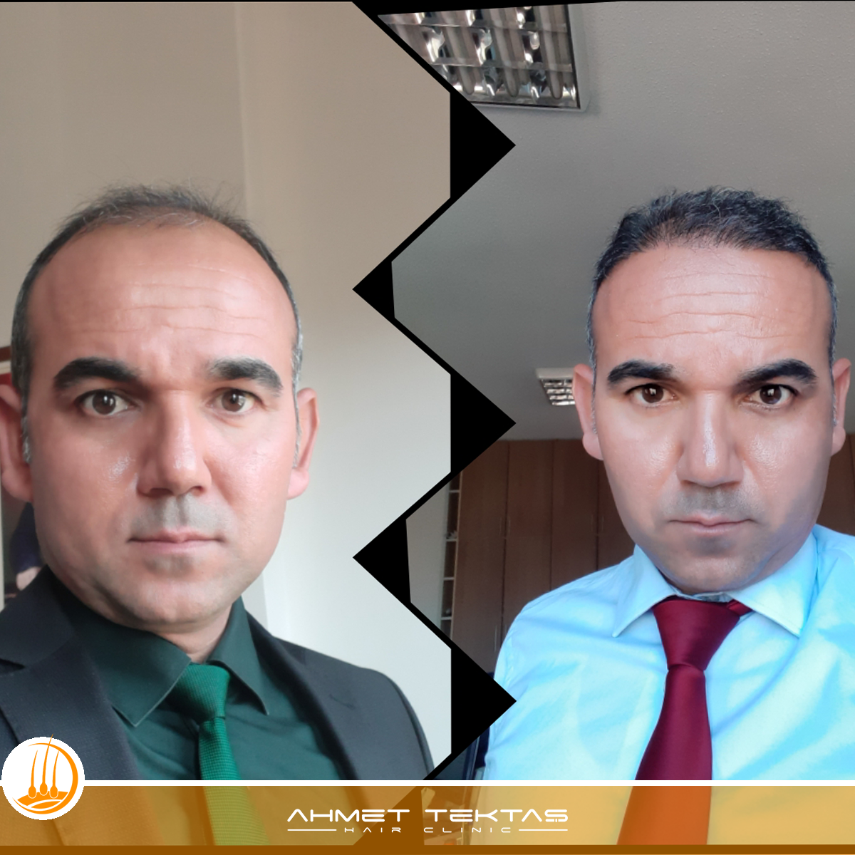 Kayseri Saç Ekimi, Hüseyinn Bey Kayseri Saç Ekimi, Hüseyinn Bey