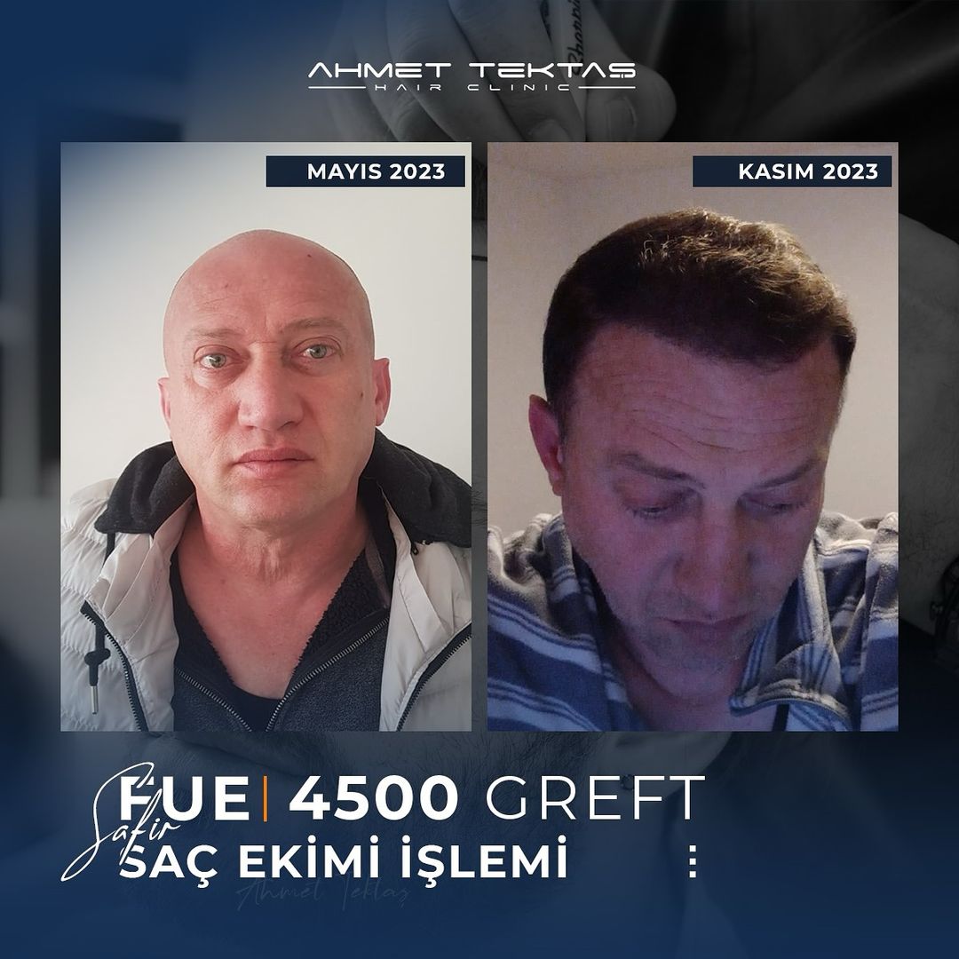 Kayseri Saç Ekimi, Muhsin Bey Kayseri Saç Ekimi, Muhsin Bey