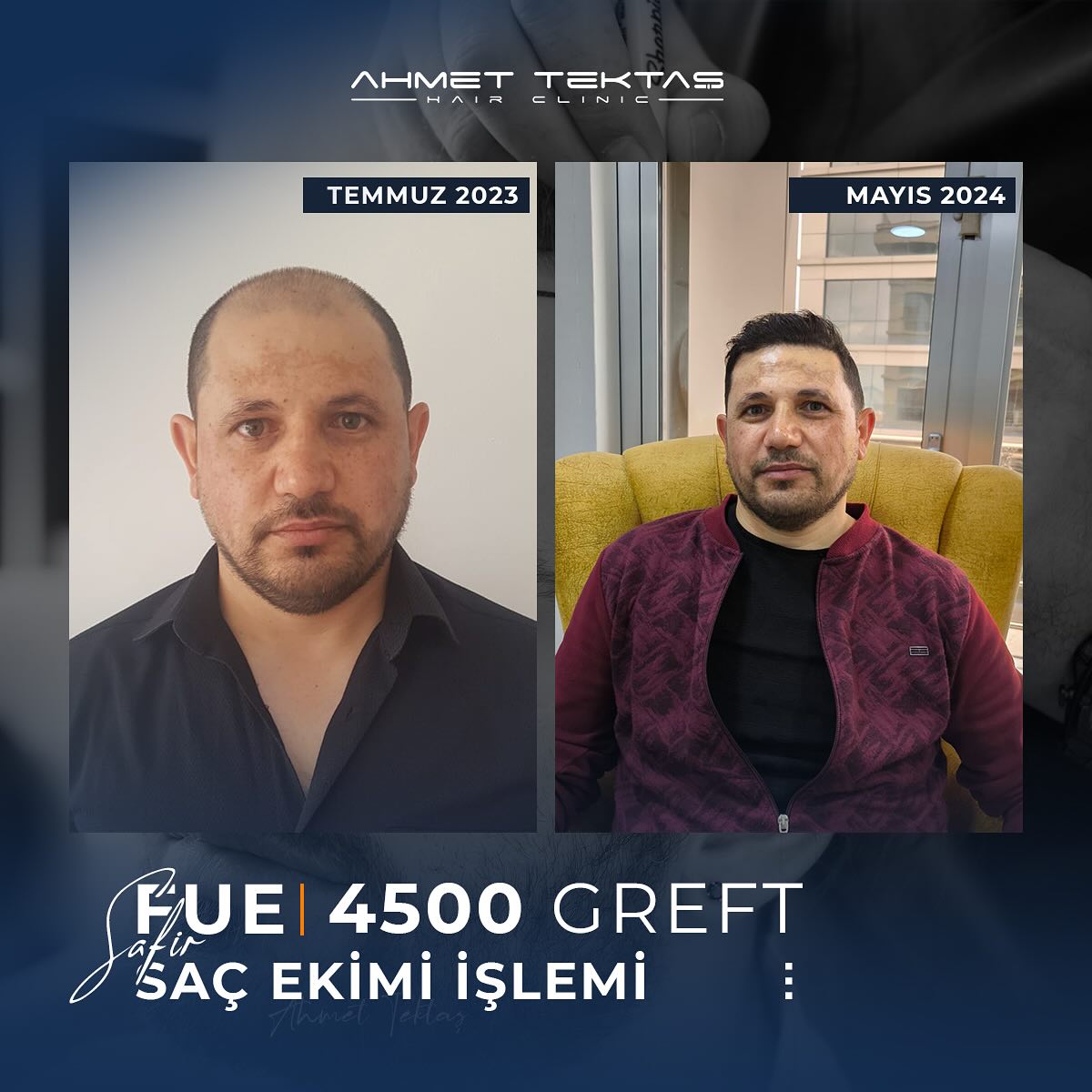 Kayseri Saç Ekimi, Salih Bey Kayseri Saç Ekimi, Salih Bey