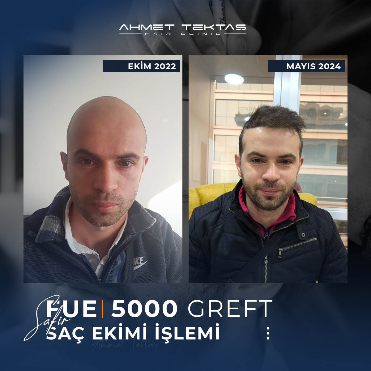 Kayseri Saç Ekimi, Yakup Bey Kayseri Saç Ekimi, Yakup Bey
