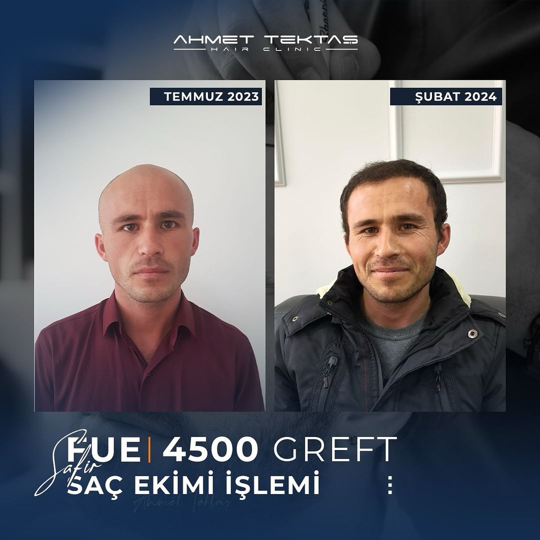 Kayseri Saç Ekimi, Yakut Bey Kayseri Saç Ekimi, Yakut Bey