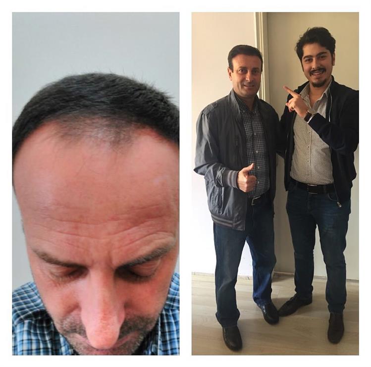 Kırşehir Saç Ekimi Kırşehir Saç Ekimi