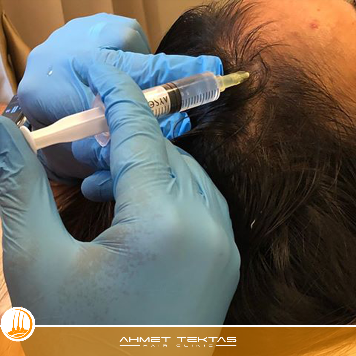 Kırşehir Saç Mezoterapisi