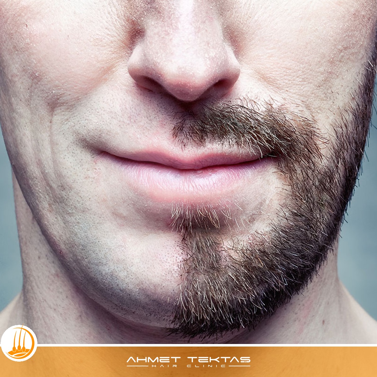 Nevşehir Sakal Ekimi