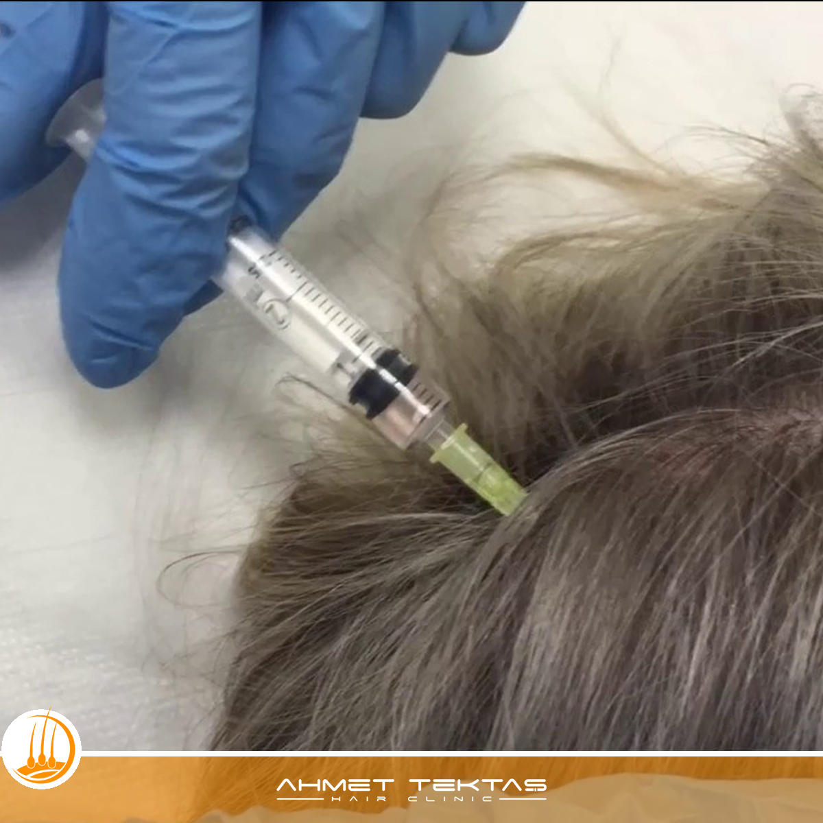 Niğde Saç Mezoterapisi