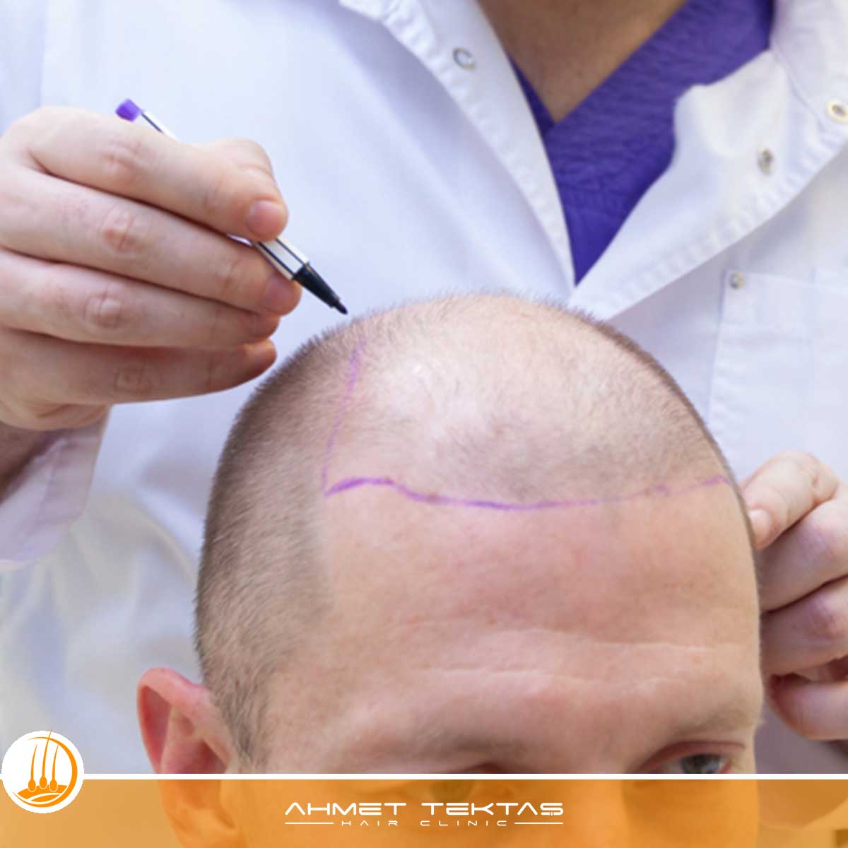 Niğde VIP Saç Ekimi