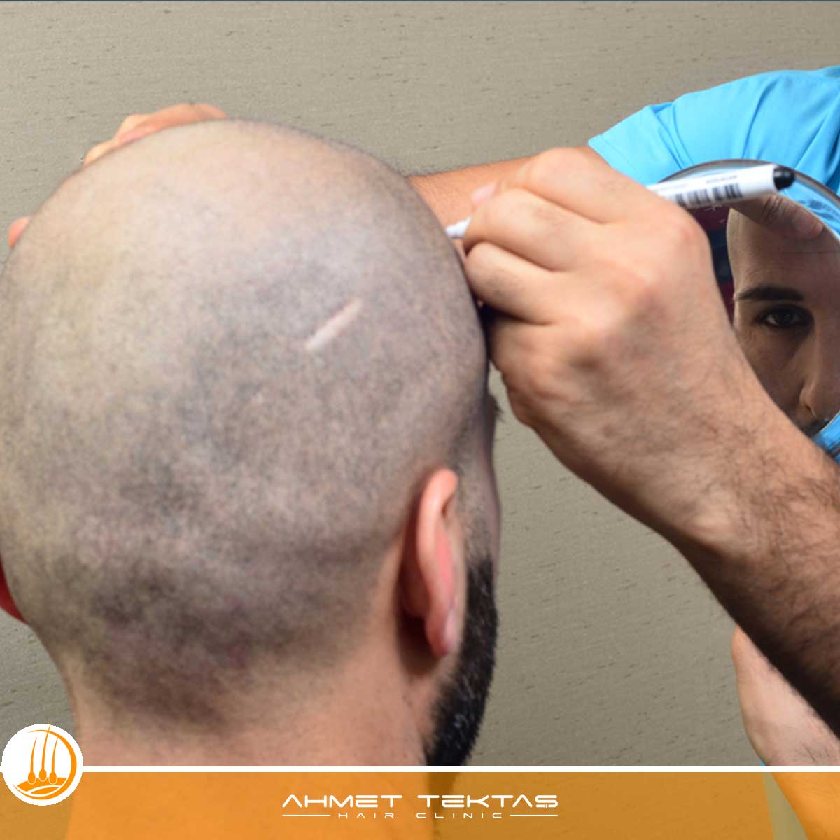 Niğde VIP Saç Ekimi