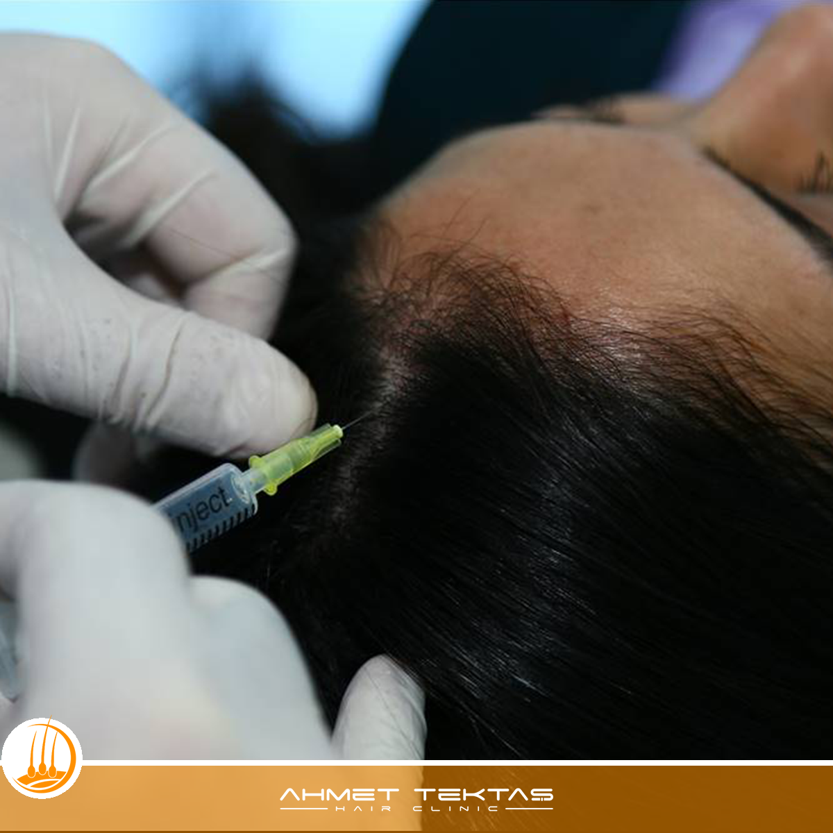 Sivas Saç Mezoterapisi