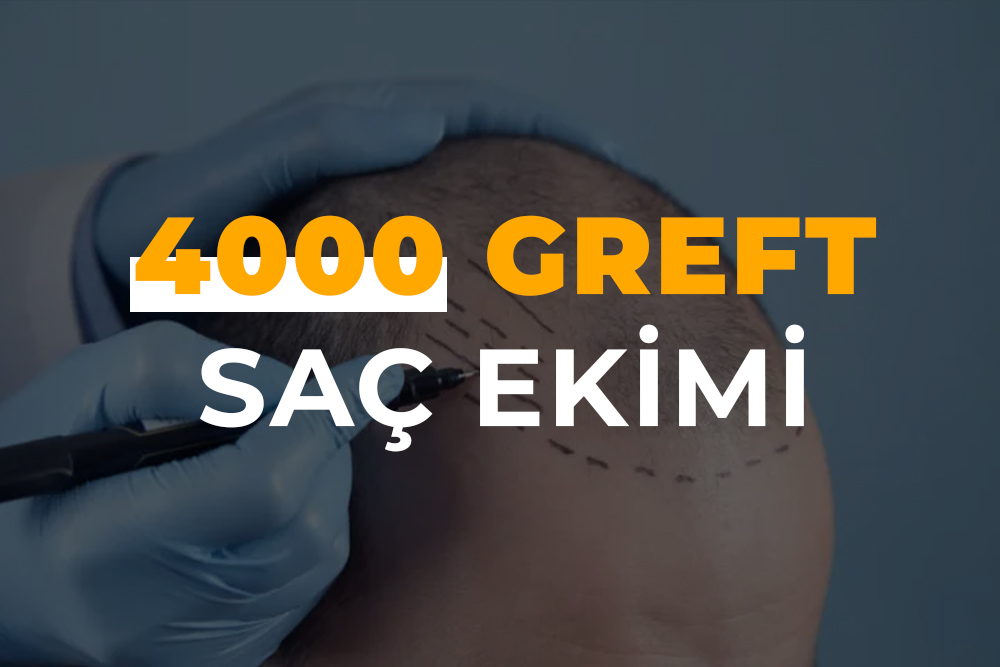 4000 Greft Saç Ekimi (4000 Kök Saç Ekimi )