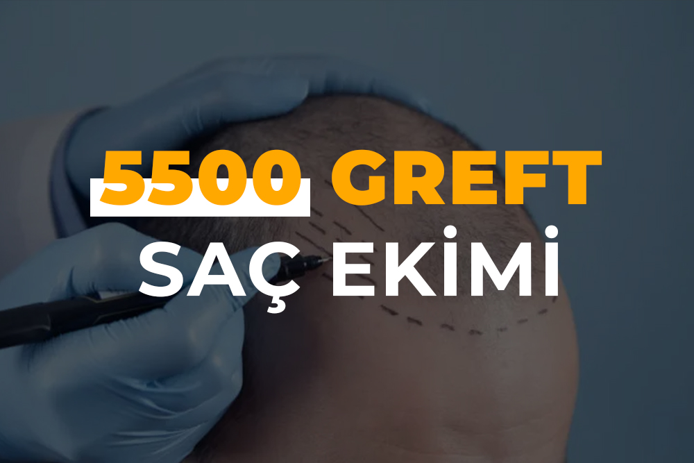 5500 Greft Saç Ekimi (5500 Kök Saç Ekimi )