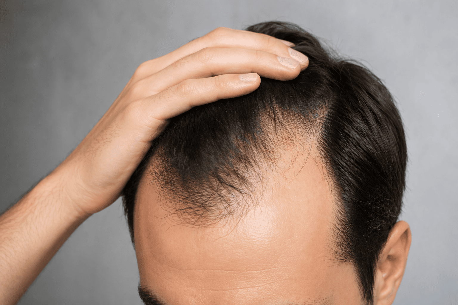 DHT Hormonu Nedir? Saç Dökülmesine Etkisi ve Çözüm Yolları