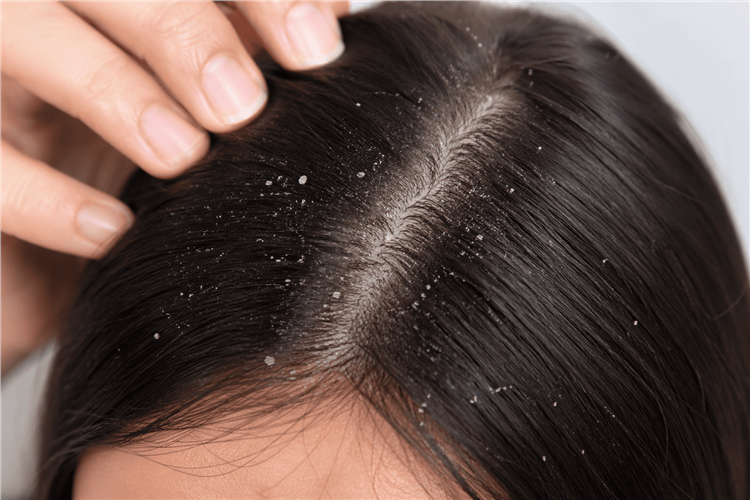 Saç Derisinde Kabuklanma Neden Olur ve Nasıl Geçer?